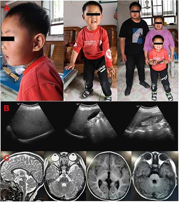 SINO Syndrome Causative KIDINS220/ARMS Gene Regulates Adipocyte Differentiation